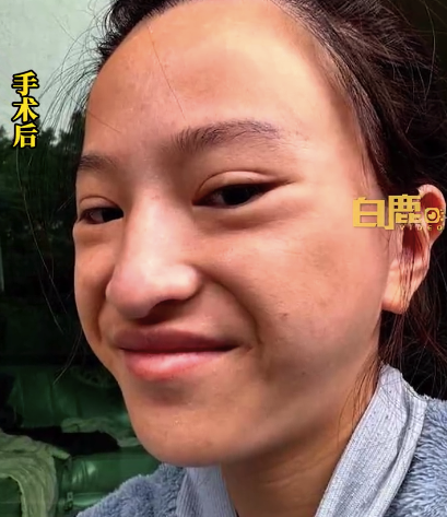 29岁女子称7万元做磨骨后火箭式衰老：面部下垂法令纹明显
